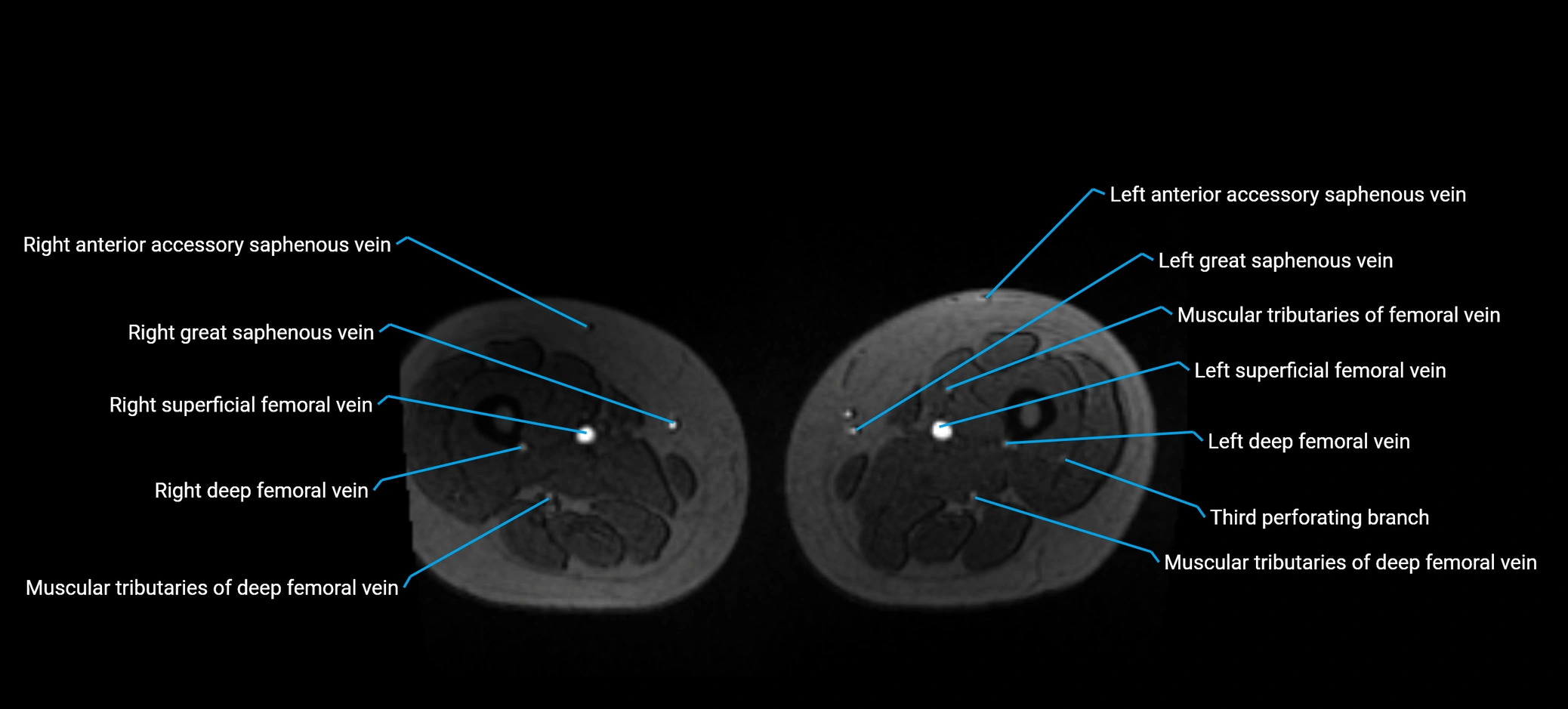 MRV abdomen pelvis & lower limb axial cross sectional anatomy labelled MRI image 278 (1).webp